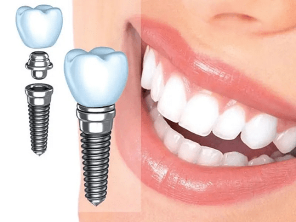 مزایای ایمپلنت دندان جلو در اصلاح طرح لبخند