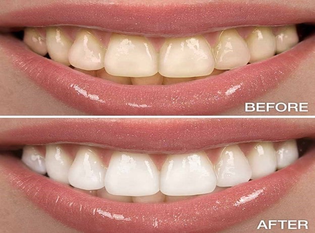 مزایای بلچینگ دندان