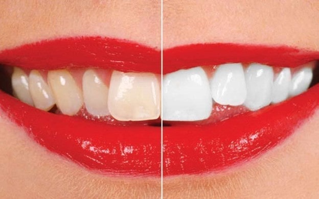 هزینه‌های مناسب بلچینگ دیگر مزیت سفید کردن دندان