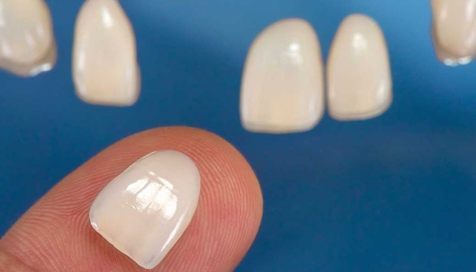 موارد موثر بر ماندگاری لمینت دندان