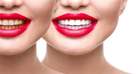 دوره درمان کوتاه بلچینگ دندان