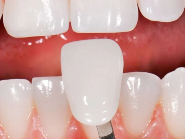 چگونه طول عمر لمینت دندان را افزایش دهیم؟