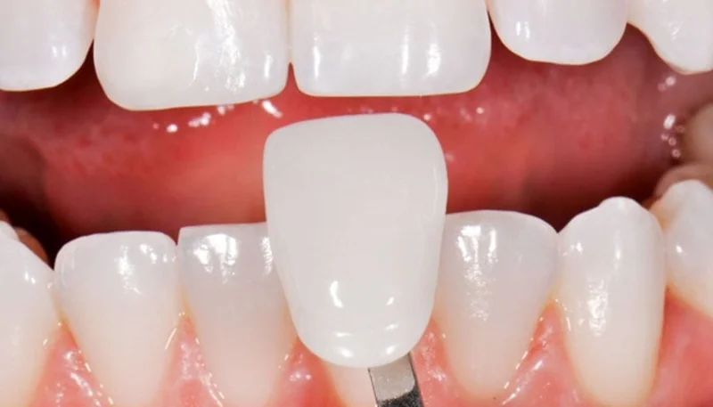 چگونه طول عمر لمینت دندان را افزایش دهیم؟